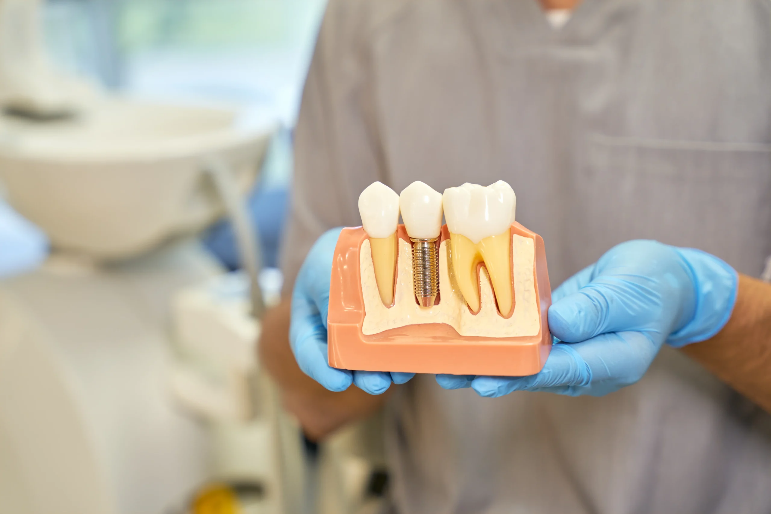 cropped-shot-of-dental-implant-model-in-hands-of-d-2022-09-29-20-18-42-utc